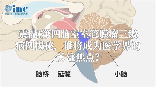 震撼!第四脑室室管膜瘤三级病例揭秘，谁将成为医学界的关注焦点？