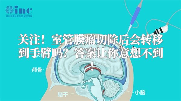 关注！室管膜瘤切除后会转移到手臂吗？答案让你意想不到！
