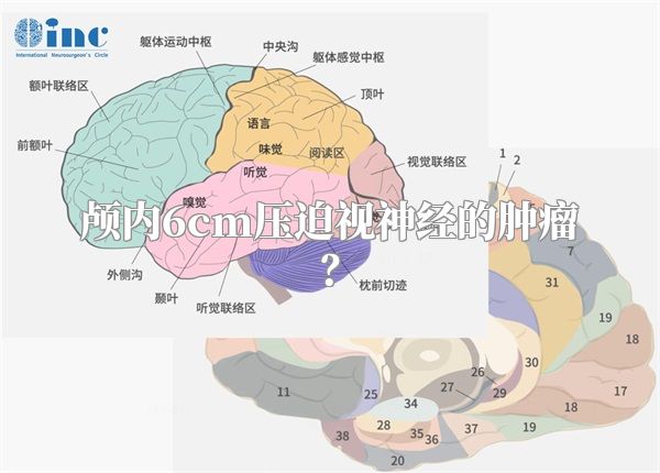 颅内6cm压迫视神经的肿瘤？