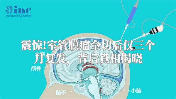 震惊!室管膜瘤全切后仅三个月复发，背后真相揭晓