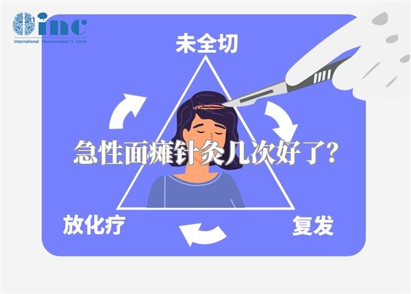 急性面瘫针灸几次好了？