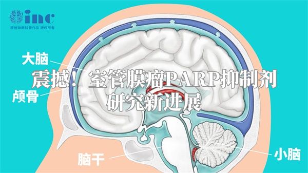 震撼！室管膜瘤PARP抑制剂研究新进展