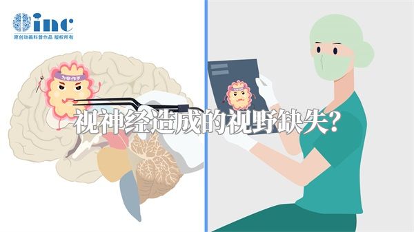 视神经造成的视野缺失?