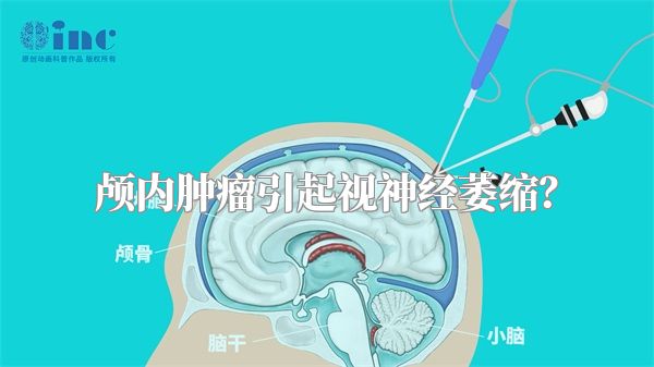 颅内肿瘤引起视神经萎缩？