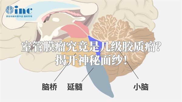 室管膜瘤究竟是几级胶质瘤？揭开神秘面纱！