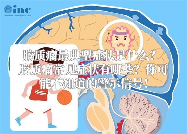 胶质瘤最典型症状是什么？ 胶质瘤常见症状有哪些？你可能不知道的警示信号！