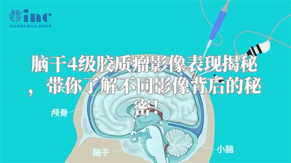 脑干4级胶质瘤影像表现揭秘，带你了解不同影像背后的秘密！