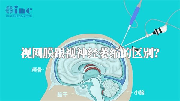 视网膜跟视神经萎缩的区别？