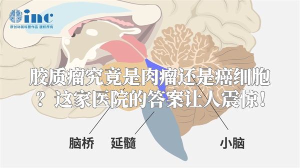 胶质瘤究竟是肉瘤还是癌细胞？这家医院的答案让人震惊！