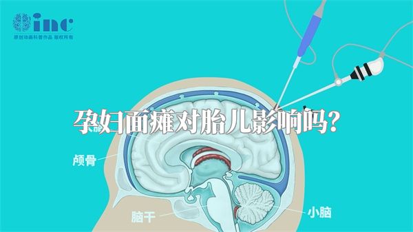 孕妇面瘫对胎儿影响吗？