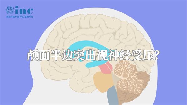 颅面半边突出视神经受压？