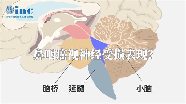 鼻咽癌视神经受损表现？