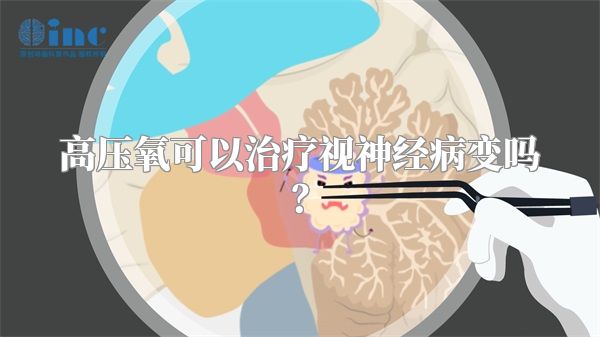 高压氧可以治疗视神经病变吗？