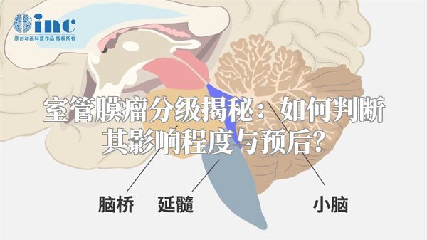 室管膜瘤分级揭秘：如何判断其影响程度与预后？