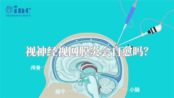 视神经视网膜炎会自愈吗?