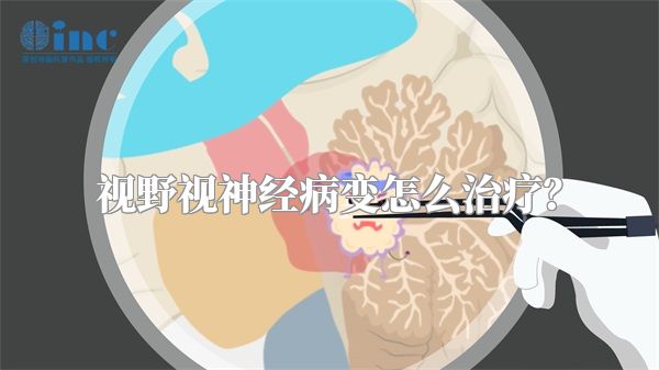 视野视神经病变怎么治疗?