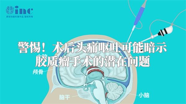警惕！术后头痛呕吐可能暗示胶质瘤手术的潜在问题