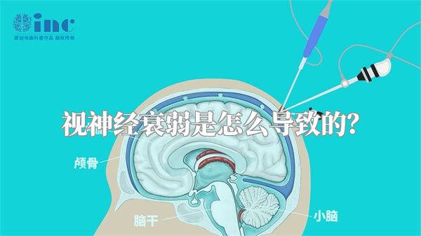 视神经衰弱是怎么导致的?