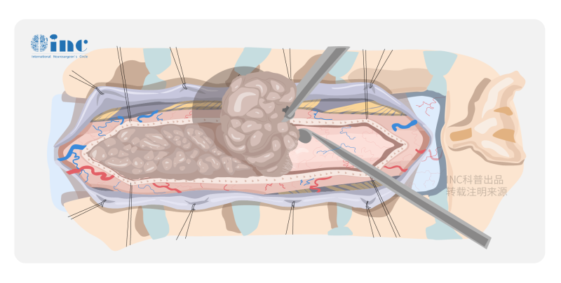 脊髓肿瘤手术