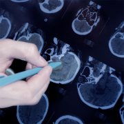 脑垂体瘤能活多久？
