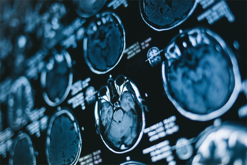 神经节细胞胶质瘤临床表现和影像学表现