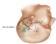 听神经瘤手术入口颅中窝入口解读。