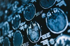 脑动脉瘤能否安全手术？